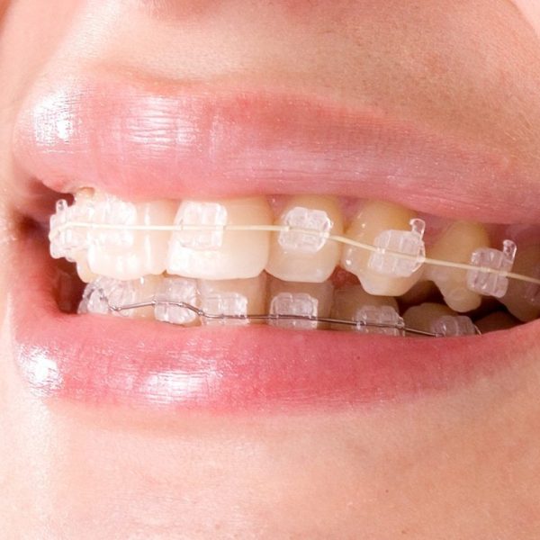 brackets-de-zafiro-1024x1024