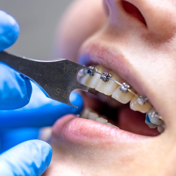 Dental procedure for installing braces close up. Dentistry. Braces on the teeth. High quality photo. Professional dental treatment. Doctor and patient. SSUCv3H4sIAAAAAAAAA41Py46DMAz8F59BCq/y+JVqDyFxqVUgVWK2WqH8+zqUaq+b04wnnhnvQBYGKC8jmqZRuWpUnRfFTeXdrejzuq3bskR1aSoFGVjNCENRVV1bqbKv+qLrlbwMRh3IwLADzfMW2Gsmt8IgisfVoj8gWmLnSc/CYgaBNW8Bg6wJM+I9iXrwj991T3MpKOFhGxOI2T9nXxnoCVfzk/xjKjKjPuKuIj1ejH45sx3fU8UEn54MrdPZSU5xyxuvjtPukcDOPMiey+8z7iRTn7Jge85OW7SnvI0LMX+ox2/C19/vGOMvYUDBooQBAAA=